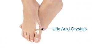 Reduce Uric Acid Naturally