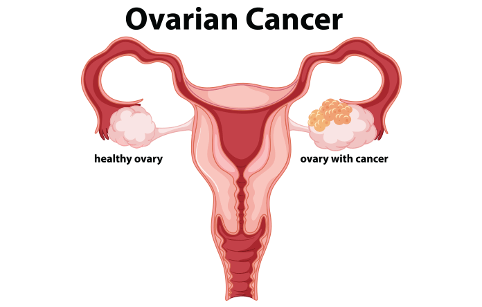 Signs of Ovarian Cancer